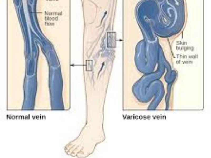 Proširene vene Proširene vene su dominantna bolest površnog venskog sistema. Oboljenja vena češće nastaju kod žena nego kod muškaraca.