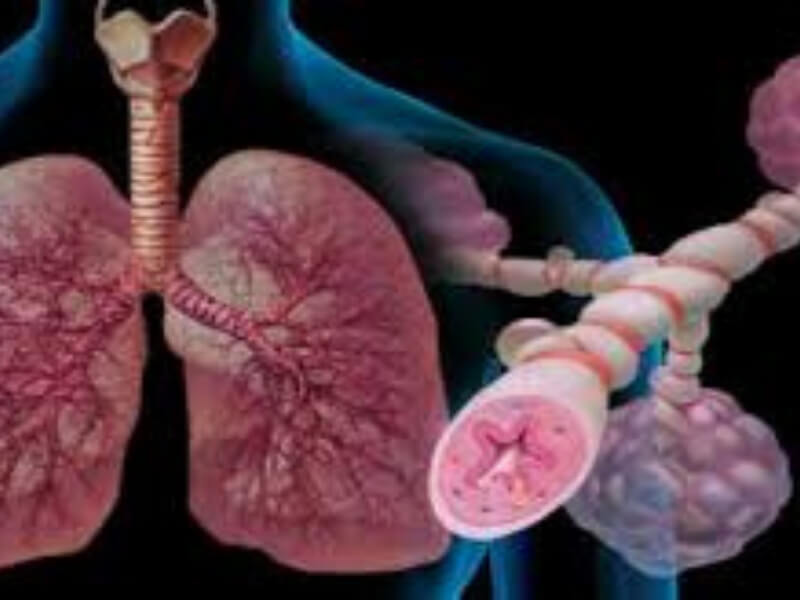 Bronhijalna astma Astma je hronična opstruktivna zapaljenska bolest disajnih puteva koja uzrokuje probleme pri disanju. Karakterišu je jak imunološki odgovor i hronična upala traheobronhijalnog stabla.