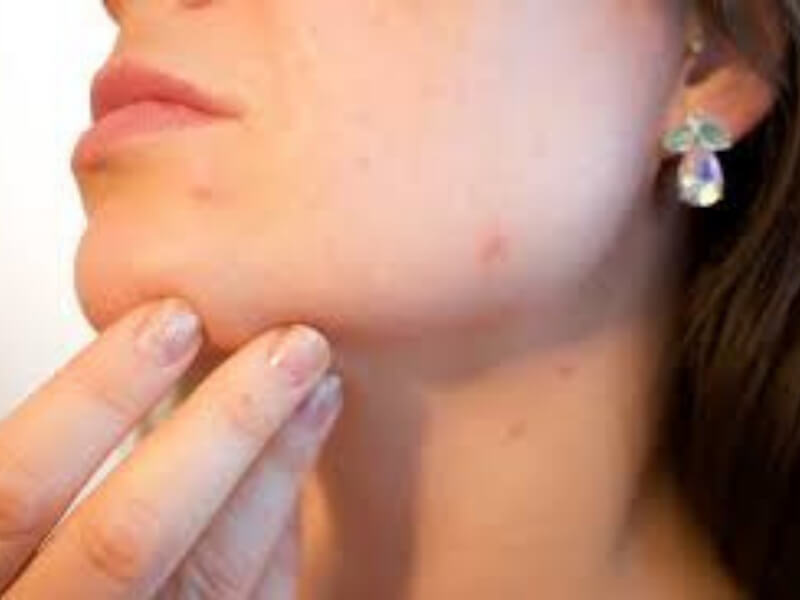 Akne kod mladih Jedna od najčešćih dermatoza seboroičnih regija (lice, leđa, grudi, ramena). Oko 80% populacije ima akne u periodu adolescencije. Akne se javljaju kod oba pola, ali kod muškog pola nešto češće i u težoj kliničkoj formi.
