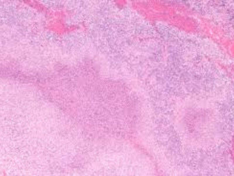 Bartonella henselae Bartonella henselae je mali, polimorfni Gram negativni bacil koji se kultiviše na običnim hranilištima. Osetljiv je na većinu antibiotika.