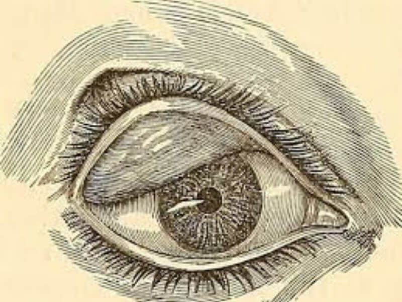 Ectropium (Ektropijum) Ektropijum je izvrtanje kapaka tako da je konjunktiva okrenuta upolje, izložena spoljnim uticajima i sasušenju, crvena je i zadebljala. Kod ektropijuma donjeg kapka izvrnutost donje suzne tačkice ne dozvoljava odvod suza, što izaziva suženje, a neprestano brisanje suza pogoršava stanje ektropijuma.