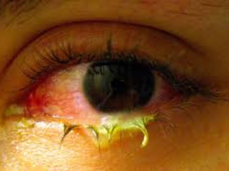 Inkluzorni konjuktivitis, uzročnik Chlamydia trachomatis Conjuncitivitis inclusoria je deo okulogenitalne infekcije izazvane određenim serološkim tipovima Chlamydiae trachomatis. Konjunktiva novorođenčeta se inficira prolazom kroz porođajne kanale. Odrasli se najčešće zaraze seksualnim putem.