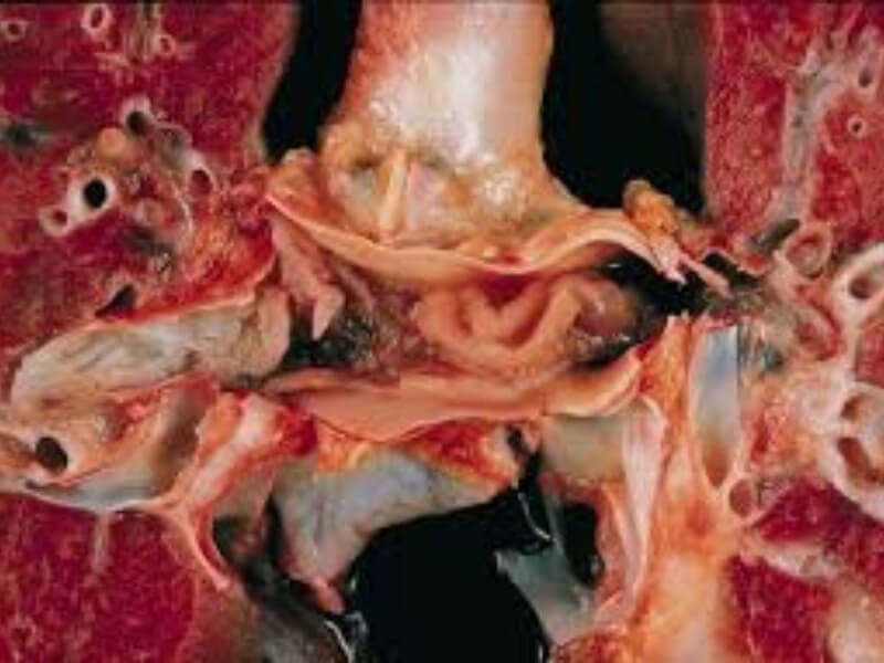 Plućna embolija Embolija pluća (EP) nastaje kada se tromb fragmentiše i odvojeni delovi (tromboembolusi), nošeni strujom krvi, dospeju u pluća. To je zapravo "plućni infarkt". Izvori embolusa u ovom slučaju su trombi koji se formiraju negde u venama tela (u stomaku, nogama i sl.) i od kojih se otkida deo i izaziva plućnu emboliju.