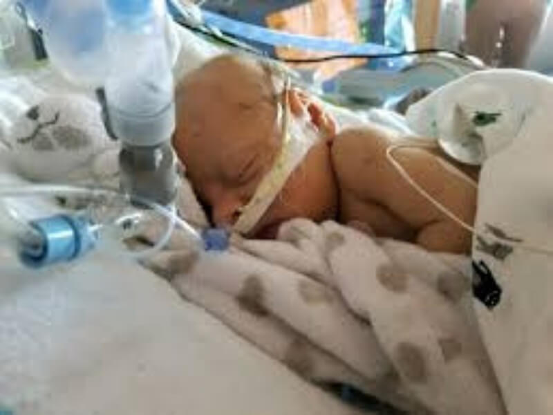 Respiratorni distres sindrom Respiratorni distres sindrom (RDS), hijalinomembranska bolest, ili hiposurfaktoza pluća klinički je entitet koji se javlja pretežno kod prevremeno rođene novorođenčadi zbog nedostatka surfaktanta.