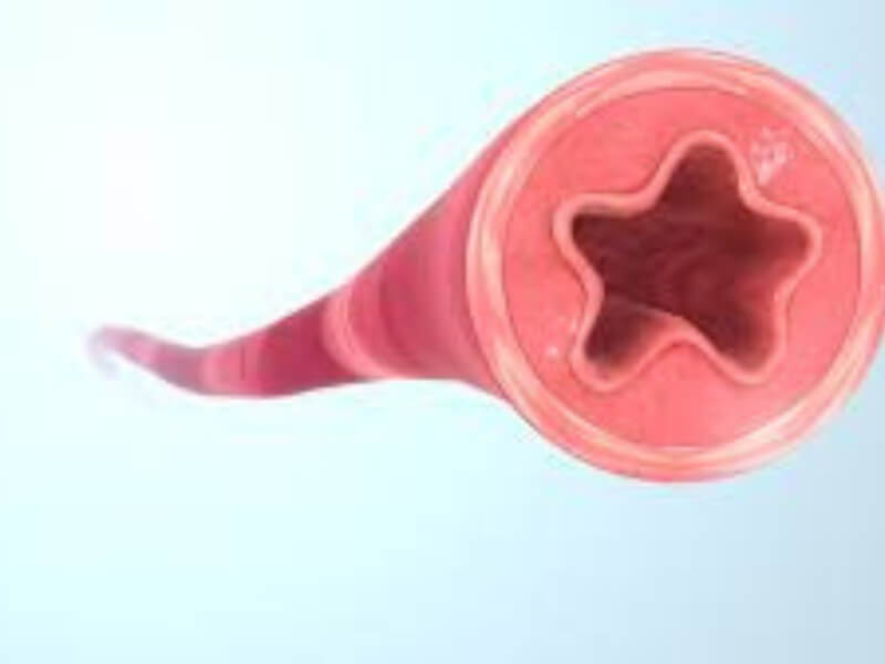 Aneurizme (ograničena proširenja krvnih sudova) Aneurizme su ograničena proširenja krvnih sudova. Najčešće se javljaju na aorti ili arterijama na periferiji. Nastaju zbog slabljenja određenog dela zida krvnog suda. Uzrokuju je ateroskleroza, gljivične infekcije, infekcije sifilisom...