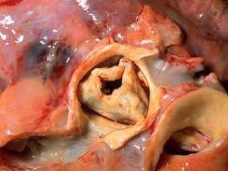 Aortna stenoza (Suženje otvora aorte) Aortna stenoza je srčana mana uslovljena suženjem aortnog otvora, koje otežava izbacivanje krvi iz leve komore u aortu.
