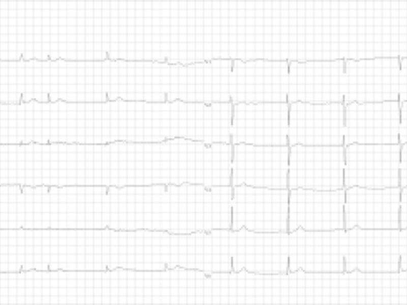 Bolest sinusnog čvora (sick sinus syndrome) Bolest sinusnog čvora je uzrokovana nesposobnošću sinusnog čvora da normalno stvara nadražaje, ili poremećajem sprovođenja impulsa od sinusnog čvora na pretkomore.