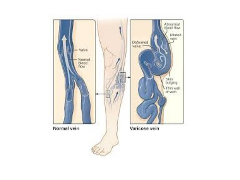 Flebotromboza (phlebothrombosis) Flebotromboza je tromboza dubokih vena, najčešće nogu, a karakteriše se okluzijom lumena, inflamatornom reakcijom zida vene i čestom pojavom embolije.