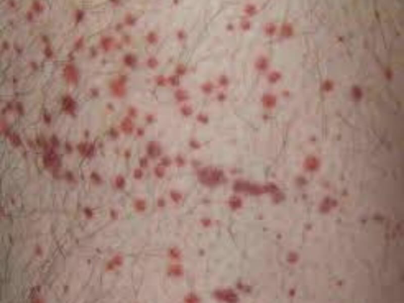 Idiopatska trombocitopenijska purpura