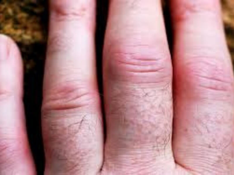 Piogeni artritis Piogeni (akutni bakterijski, septični) artritis spad u infekcijske artritise, koji su jedini među zapaljenskim oboljenjima zglobova u kojima je poznat uzročnik, koji se nalazi u samom zglobu i direktno izaziva zapaljenje.