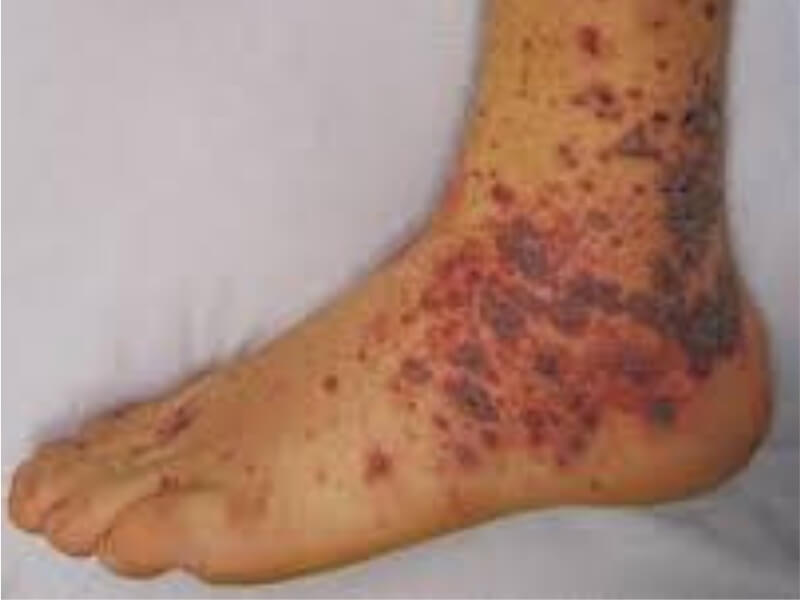 Vaskulitisi Vaskulitis predstavlja kliničko - patološki proces koji se karakteriše inflamacijom (zapaljenjem) i nekrozom (izumiranje) krvnih sudova. Patološkim procesom je obično kompromitovan lumen krvnih sudova - arterija, arteriola, kapilara i venula.