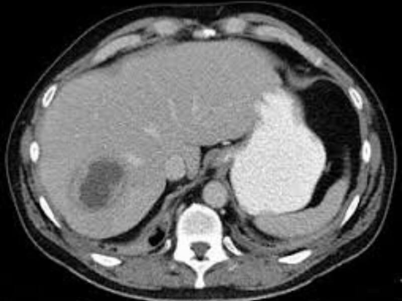 Apsces jetre Apsces jetre je retko oboljenje najčešće uzrokovano gastrointestinalnim, a ređe sistemskim infekcijama.