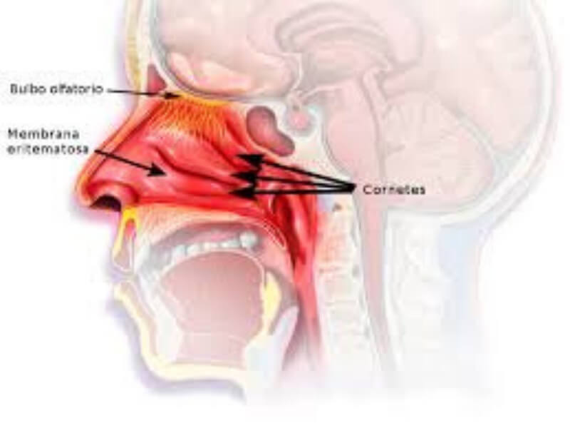 Atrofični rinitis Atrofični rinitis (rhinitis atrophica) predstavlja hronično zapaljenje sa posledičnom atrofijom uglavnom sluzokože nosa.