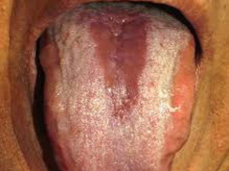 Glositis (zapaljenje jezika)