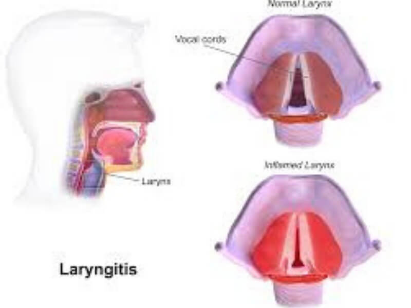 Laringitis (zapaljenje grkljana) Laringitisi su zapaljenja grkljana, obično se javljaju u sklopu zapaljenskih procesa disajnih puteva a ređe izolovano.