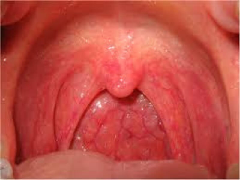 Pseudokrup Pseudokrup (laryngitis subglottica) je oblik akutnog laringitisa karakterističan za dečiji uzrast od 1. do 7. godine života.