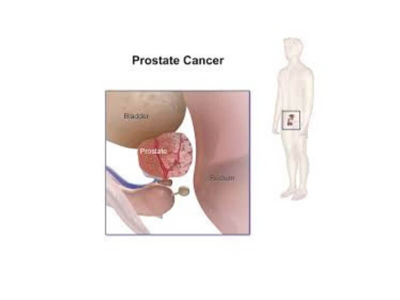 Otkriven genski indikator raka prostate Američki naučnici su pronašli genski indikator, povezan sa veoma agresivnom vrstom raka prostate. Naucnici sa Univerziteta Nortvestern u Ilinoisu ispitali su grupu od 550 muskaraca koji se leče od raka prostate.