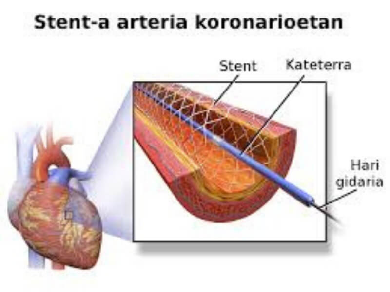 Ugradnja koronarnog stenta - procedura koja je zamenila operacije na koronarnim arterijama