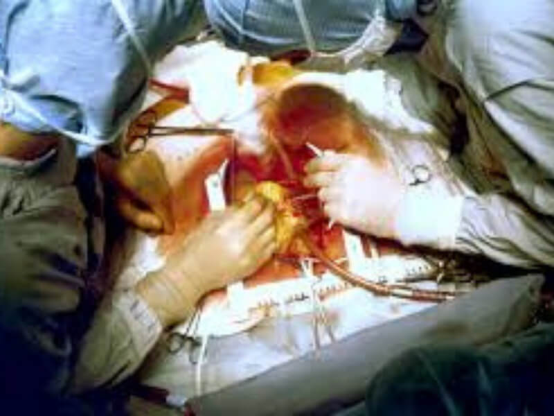 Izbacivanje tromba u akutnom infarktu po prvi put uradjen u Srbiji Po prvi put u Srbiji u akutnom infarktu miokarda, upotrebljen je sistem ThromCat za usitnjavanje, usisavanje i izbacivanje tromba koji je odgovoran za infarkt miokarda.