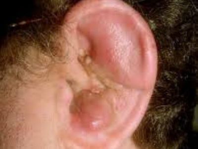 Perihondritis predstavlja infekciju hrskavice ušne školjke koja može da dovede i do nekroze i deformiteta.