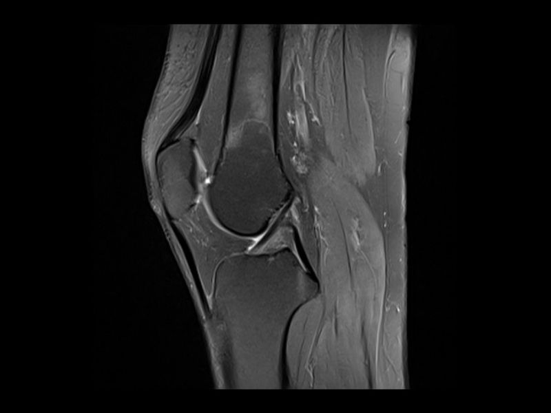 Magnetna rezonanca kolena (MR kolena)