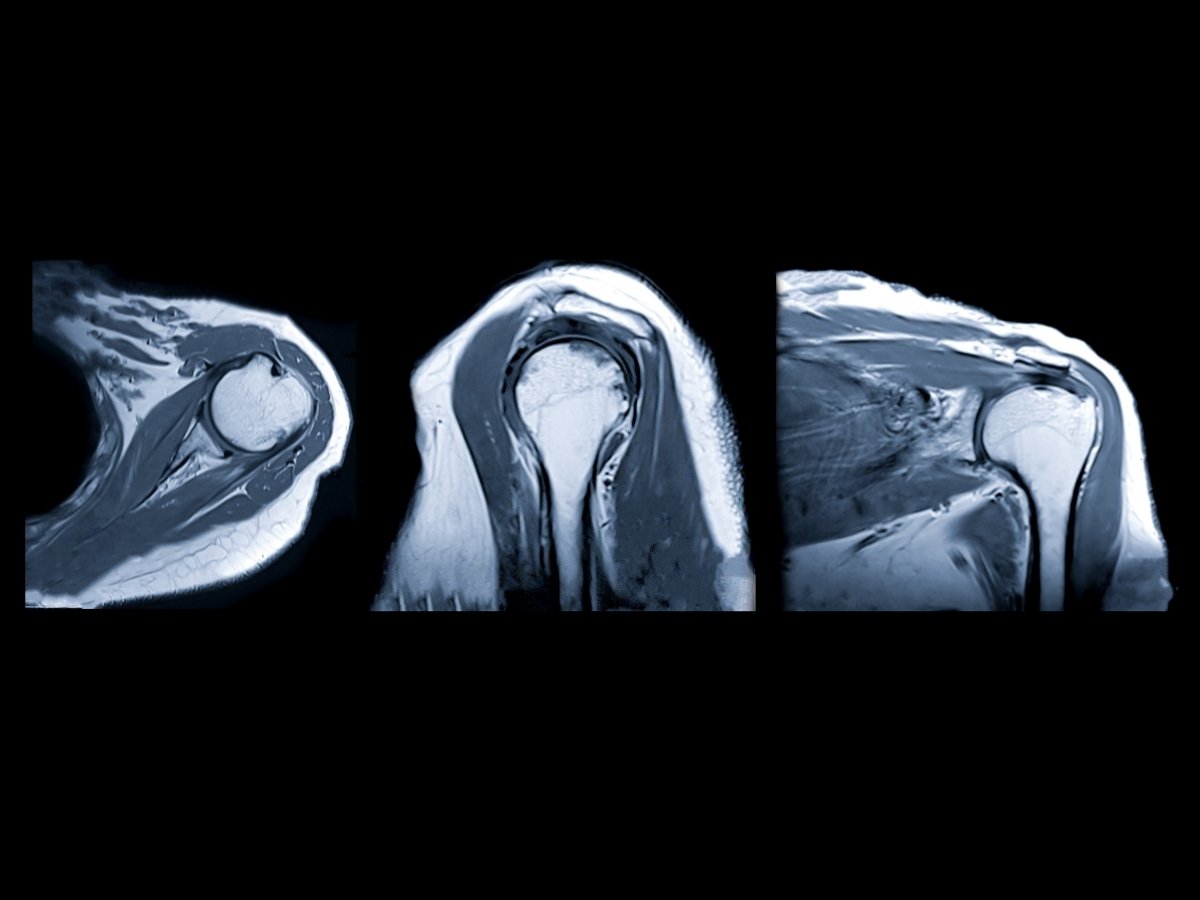 Magnetna rezonanca ramena (MRI ramena)