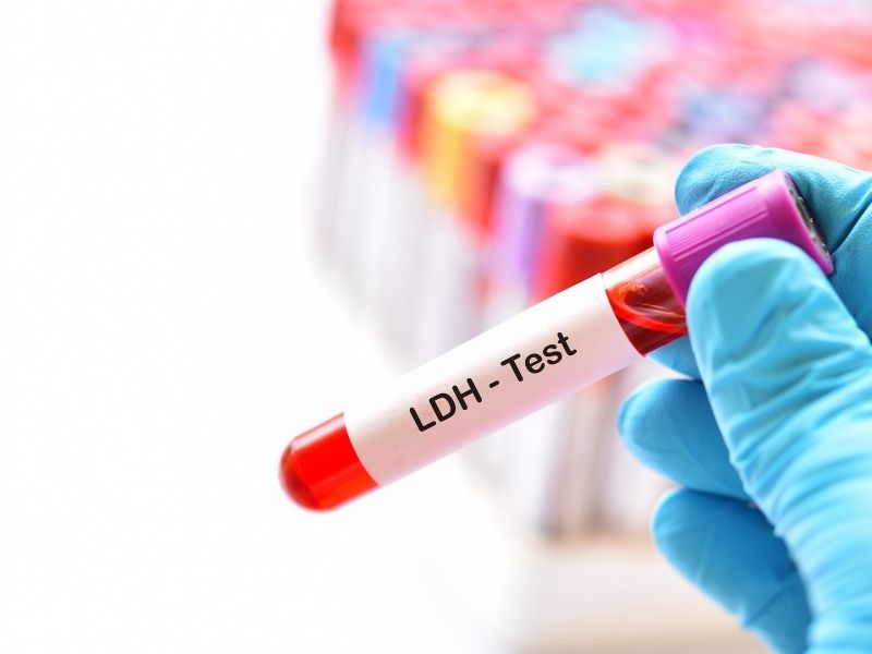 Zašto je povišena laktatdehidrogenaza (LDH) u krvi?