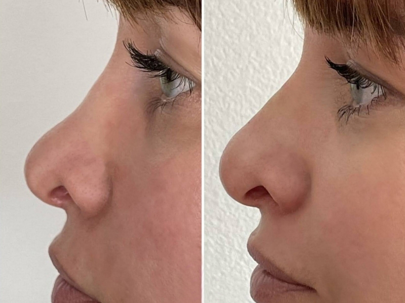 Nehiruška korekcija nosa (Korekcija nosa hijaluronom)