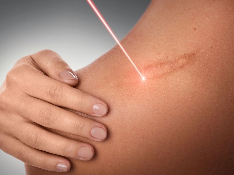 Lasersko uklanjanje ožiljaka
