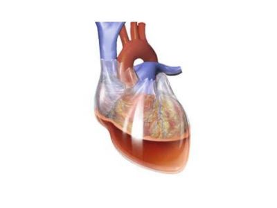 Tamponada srca nastaje kao posledica nagomilovanja tečnosti ili vazduha u perikardnom prostoru, pri čemu dolazi do povećanja intraperikardnog pritiska koji ograničava dijastolno punjenje sa redukcijom udarnih volumena i padom minutnog volumena.