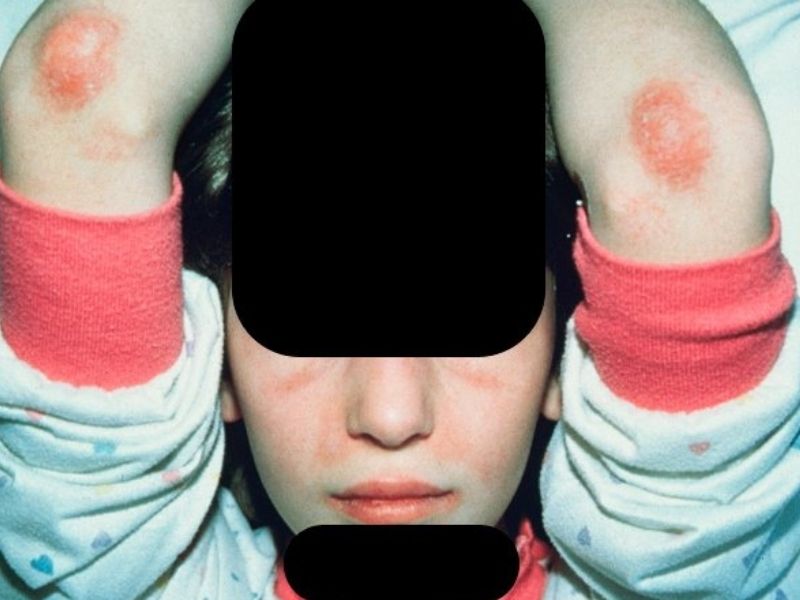 Juvenilni dermatomiozitis (JDM - Juvenile dermatomyositis)