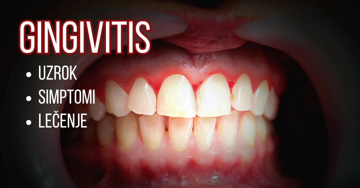 Gingivitis (upala desni) uzrok, simptomi, lečenje