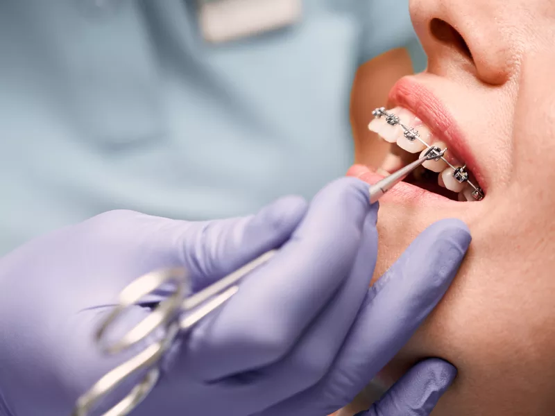 Ortodontski aparati i oralna higijena