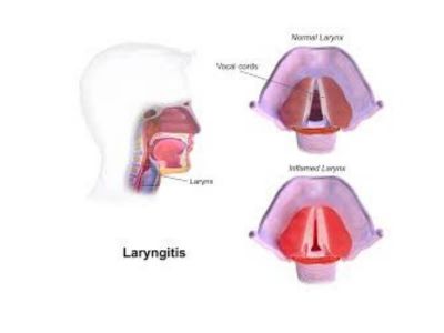 Akutni hemoragični laringitis (laryngitis acuta haemorrhagica) nastaje kod naglog, eksplozivnog zatvaranja glotisa pri jakom vikanju, pa se stvara submukozno krvarenje.