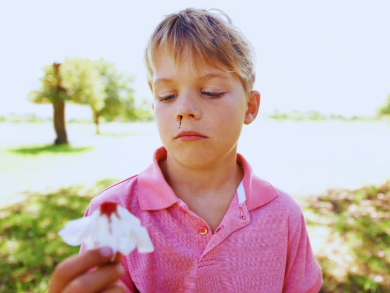 Krvarenje iz nosa kod dece – kada je znak za brigu?