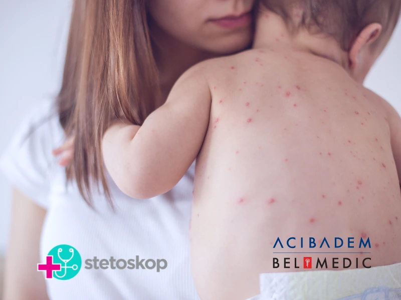 Varičele (ovčije boginje) kod dece: simptomi i lečenje