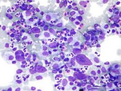 Non - Hočkin limfom je maligna proliferacija limfatičnih ćelija imunog sistema, uključujući limfne čvorove, koštanu srž, slezenu, jetru i sistem za varenje. Ova bolest je znatno učestalija od Hočkinovog limfoma.
