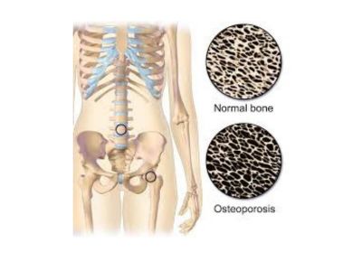 Postmenopauzna osteoporoza predstavlja postepeno smanjenje koštane mase i poremećaj kvaliteta kosti što dovodi do veće krtosti kostiju i fraktura. Najveći broj faktura se dešava kod postmenopauznih žena.