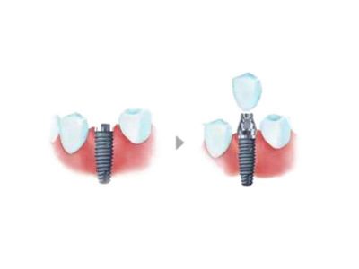 Zubni implant predstavlja šraf koji se ugrađuje u kost, abatment i same krunice, koja je jedini vidljivi deo implanta. Pročitajte sve informacije o zubnim implantima.