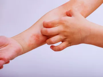 Ekcem - vrste i lečenje