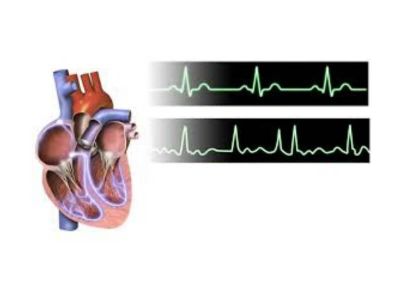 Atrijalni septalni defekt (ASD) predstavlja jednu od najčešće nalaženih urođenih srčanih mana kod odraslih. Defekt tipa sinus venosus je lokalizovan visoko na međupretkomorskoj pregradi, u blizini ušća vene cave superior.