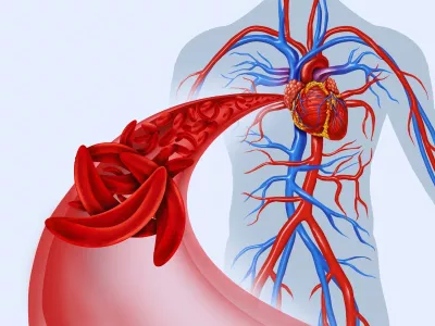 Oko 25% pacijenata sa šećerenom bolesti ima perifernu arterijsku bolest.