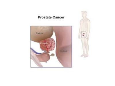 Američki naučnici su pronašli genski indikator, povezan sa veoma agresivnom vrstom raka prostate. Naucnici sa Univerziteta Nortvestern u Ilinoisu ispitali su grupu od 550 muskaraca koji se leče od raka prostate.