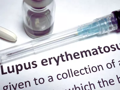 Sistemske bolesti vezivnog tkiva - eritremski lupus Sistemske bolesti vezivnog tkiva (SBVT) su velika grupa zapaljenskih autoimunskih bolesti koje mogu zahvatiti gotovo sve organe i tkiva.