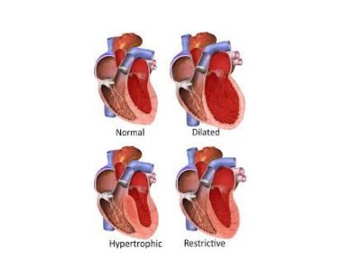 Restriktivna kardiomiopatija se odlikuje poremećenom dijastolnom relaksacijom komora, usled rigidnih zidova komora srca, čime je, onemogućeno njihovo adekvatno punjenje krvlju.