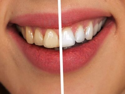 Beljenje zuba je stomatološka intervencija koja daje trenutne rezultate, a može se obaviti u jednoj poseti ordinaciji ili u kućnim uslovima. Kombinacija više tehnika beljenja zuba predstavlja najbolji izbor za postizanje željenih rezultata. Terapija je gotovo kada nakon dva uzastopna kontrolna pregleda ustanovimo istu nijansu zuba.