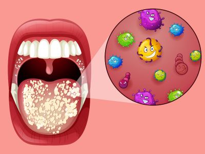 Kandida je infekcija do koje dolazi bujanjem gljivica kada je poremećena imunološka ravnoteža. Pročitajte koji su to simptomi kandide i kako se kandida leči.