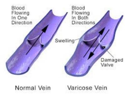 Proširene vene su dominantna bolest površnog venskog sistema. Pod proširenim venama podrazumevaju se dilatirane, izuvijugane i prominentne površne vene na nogama.