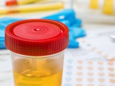Analiza urina je jedna od korisnijih screening metoda čiji rezultati mogu dati osnovne informacije o stanju metabolizma i o stanju genitalno-urinarnog sistema.