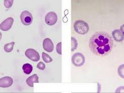 Megaloblastne anemije nastaju zbog smanjene sinteze DNK. Većina megaloblastnih anemija izazvana je nedostatkom vitamina B12 (perniciozna anemija) i/ili folne kiseline.